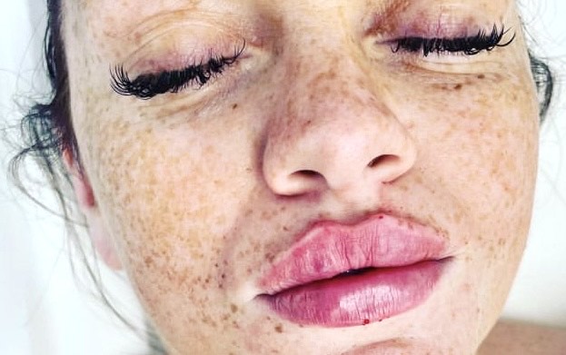 Lip filler