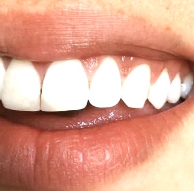 Teeth Whitening